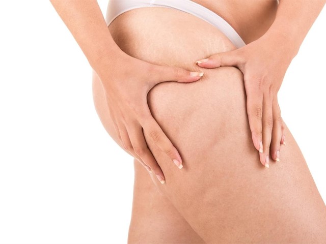 Celulitis: qué es y cómo tratarla