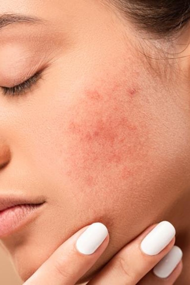 Te ayudamos a eliminar manchas de la piel en Ribeira